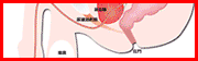 前立腺マスター